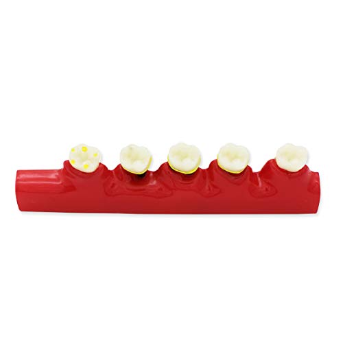 מודל שיני שיניים D-PE, דגם שיניים שיניים שקוף שיניים דגם רופא שיניים מחלה סטנדרטית. מודל הוראה פתולוגי נשלף נשלף