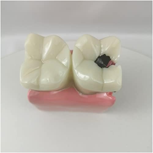 Kh66zky שיניים שיניים דגם שיניים - 6 פעמים ריקבון שיניים מודל מחקר השוואתי - השוואה בין מודל שיניים פתולוגיה להוראה לימוד